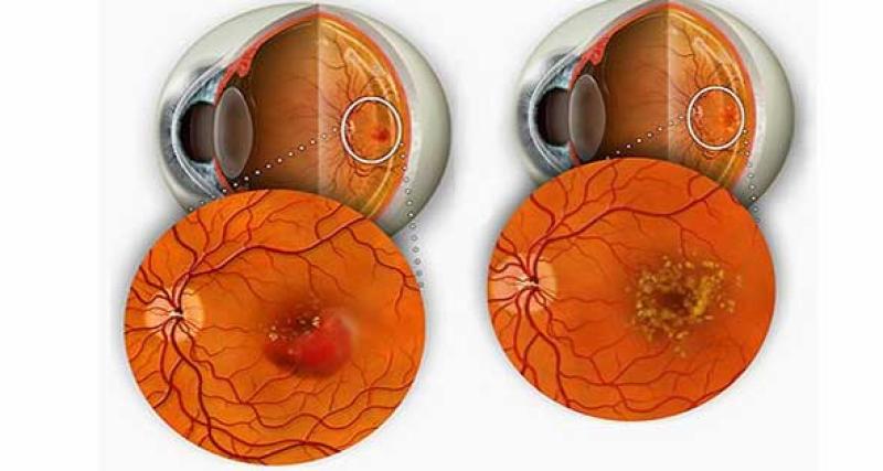 ثقب الابصار مركز مبارك الفاران لعلاج امراض العيون