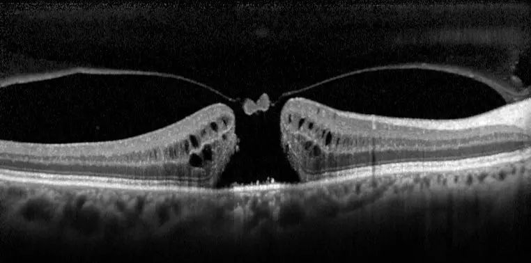 ثقب الابصار مركز مبارك الفاران لعلاج امراض العيون
