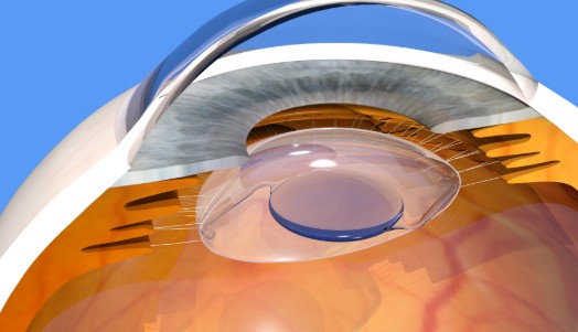 زراعة عدسات متعددة