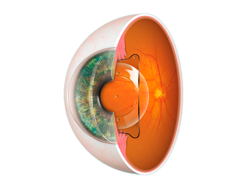 زراعة عدسات أحادية