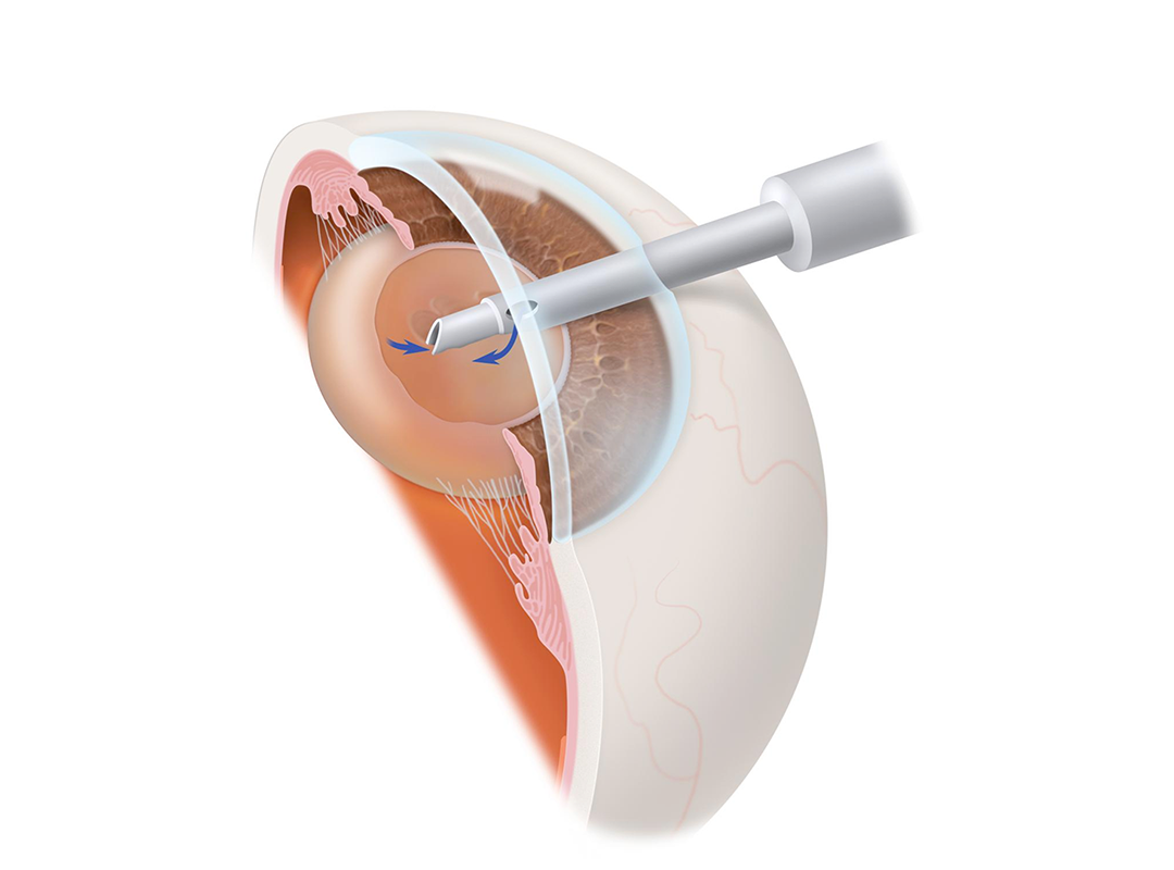 جراحة الفاكو